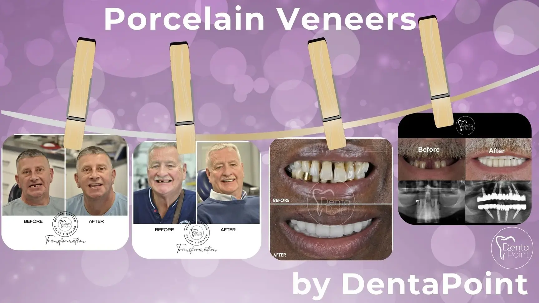 Porcelain Veneers Before After Photos İn Turkey İzmir