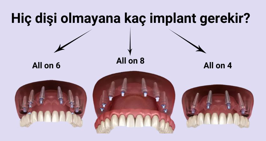 Hiç dişi olmayana kaç implant yapılmalı? İzmir