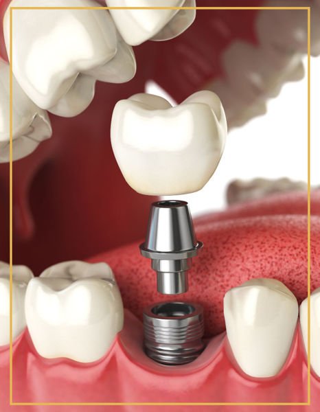 Vidalı İmplant Dişler Denta Point Ağız ve Diş Sağlığı Polikliniği