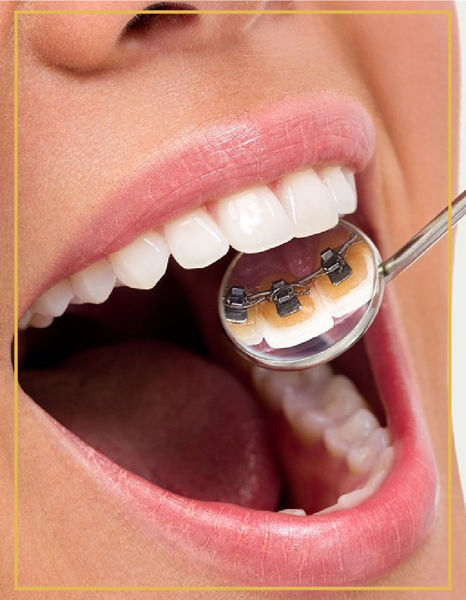Lingual Ortodonti (Görünmeyen Diş Teli) Karşıyaka ve Bostanlı DentaPoint