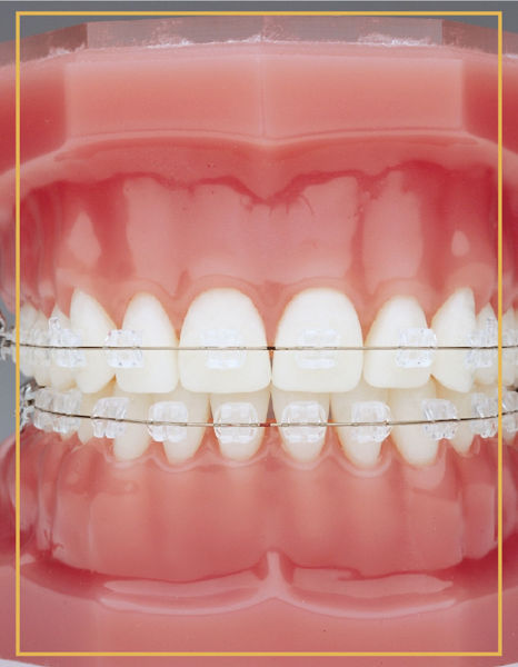 Karşıyaka Şeffaf Bralet ile Ortodonti | Bostanlı Şeffaf Bralet ile Ortodonti | İzmir Şeffaf Bralet ile Ortodonti 
